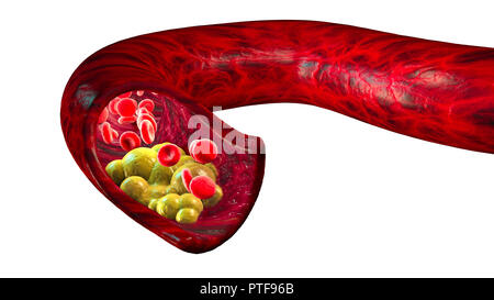 Die Bildung von Cholesterin, Fett, Arterie, Vene, Herz. Rote Blutkörperchen, Blut fließen. Einengung der Vene für fat Bildung Stockfoto