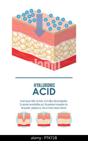 Hyaluronsäure filler Injektion Infografik Stock Vektor