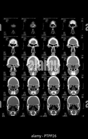 Kopf in der Computertomographie, CT-Bild Stockfoto