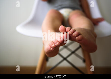 Baby Beine mit schuppiger Haut. Ekzem, Allergie, Pilzinfektion Stockfoto