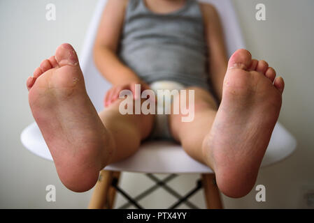 Baby Beine mit schuppiger Haut. Ekzem, Allergie, Pilzinfektion Stockfoto