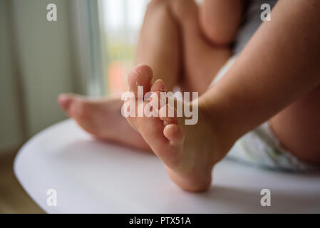 Baby Beine mit schuppiger Haut. Ekzem, Allergie, Pilzinfektion Stockfoto