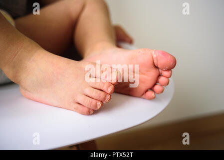 Baby Beine mit schuppiger Haut. Ekzem, Allergie, Pilzinfektion Stockfoto