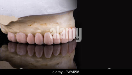 Wachs Muster Zähne Zahnkronen nach Modell, frei von Metallen - von vorne. Vorne Keramik Veneers auf schwarzem Hintergrund isoliert. Metal-Ceramic Kronen auf Gips Modell im Dentallabor. Stockfoto
