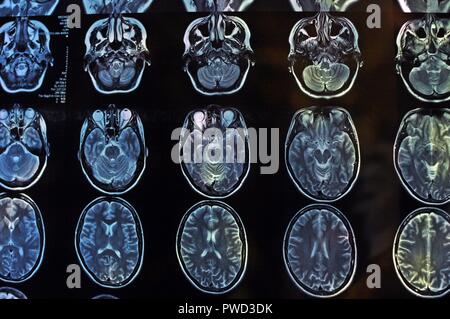 Magnetic Resonance Image Scan des Gehirns. Mrt-Film von einem menschlichen Schädel und Gehirn. Neurologie Hintergrund. Medizin, Wissenschaft, Vorderansicht Stockfoto