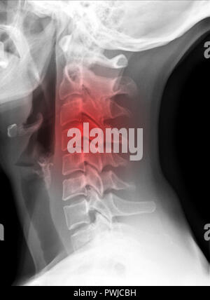 X-ray Picture-Hws mit rotem Symbol der schmerzhaften Stelle Stockfoto