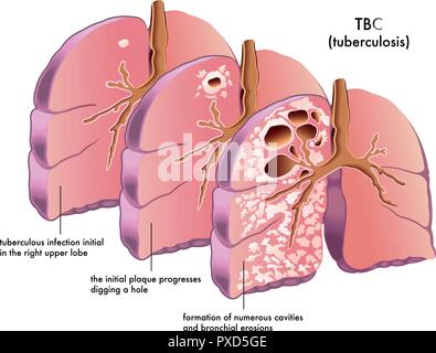 Vektor medizinische Illustration der Symptome einer Tuberkulose Stock Vektor