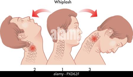 Vektor medizinischen Abbildung der Dynamik des Schleudertraumas Stock Vektor