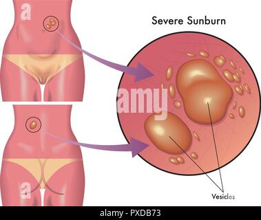 Medizinische Illustration der Folgen schwerer Sonnenbrand Stock Vektor