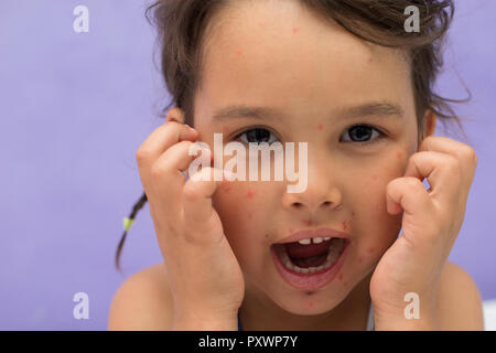 Kleines Mädchen mit Huhn pox seine Stösse kritzeln Stockfoto
