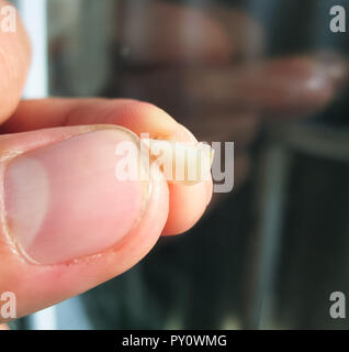 Gefallenen aus alte Füllung mit einem Cutter. Die Dichtung des Zahnes. Stockfoto
