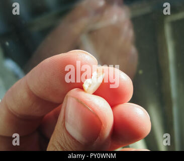 Gefallenen aus alte Füllung mit einem Cutter. Die Dichtung des Zahnes. Stockfoto