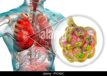Bakterielle Pneumonie. Computer Abbildung: stabförmige Bakterien (Bakterien) in den Alveolen der Lunge, was zu einer Infektion der unteren Atemwege. Das ist im Allgemeinen als Lungenentzündung bekannt, obwohl der Begriff auch für bestimmte Arten von Infektionen reserviert werden kann. Schwere Lungenentzündung diagnostiziert werden von X-ray und mit Antibiotika behandelt. Die alveolen sind der Website der Gasaustausch zwischen der Luft in die Lunge und das Blut. Stockfoto