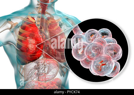 Bakterielle Pneumonie. Computer Abbildung: stabförmige Bakterien (Bakterien) in den Alveolen der Lunge, was zu einer Infektion der unteren Atemwege. Das ist im Allgemeinen als Lungenentzündung bekannt, obwohl der Begriff auch für bestimmte Arten von Infektionen reserviert werden kann. Schwere Lungenentzündung diagnostiziert werden von X-ray und mit Antibiotika behandelt. Die alveolen sind der Website der Gasaustausch zwischen der Luft in die Lunge und das Blut. Stockfoto
