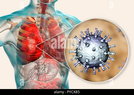 Lungenentzündung verursacht durch Varicella zoster Virus (VZV), computer Abbildung. VZV ist ein Virus aus der Familie Herpesviridae, der Erreger der Windpocken und Gürtelrose. In schweren Fällen VZV kann dazu führen, dass Komplikationen, wie eine Lungenentzündung und Enzephalitis. Stockfoto