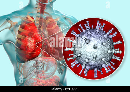 Lungenentzündung verursacht durch Varicella zoster Virus (VZV), computer Abbildung. VZV ist ein Virus aus der Familie Herpesviridae, der Erreger der Windpocken und Gürtelrose. In schweren Fällen VZV kann dazu führen, dass Komplikationen, wie eine Lungenentzündung und Enzephalitis. Stockfoto
