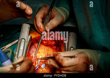 Ein Chirurg führt einer aortokoronaren Bypass Operation am offenen Herzen Arterie Stockfoto