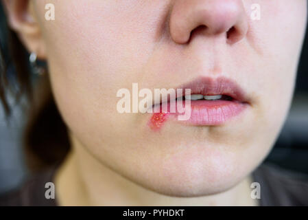 Herpes auf junge Frau Lippen. Nahaufnahme Stockfoto