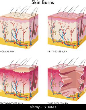 Medizinische Abbildung: die Bildung von Verätzungen der Haut Stock Vektor