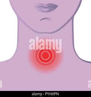 Medizinische Darstellung der Symptome der Halsschmerzen Stock Vektor