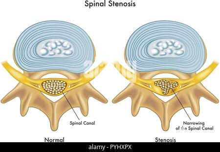 Medizinische Illustration der Auswirkungen von Spinale Stenose Stock Vektor