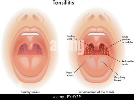 Medizinische Darstellung der Symptome der Mandelentzündung Stock Vektor