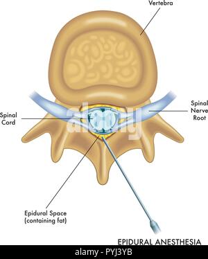 Vector Illustration einer medizinischen Narkose Methode namens epidurale Anästhesie, auf einem weißen Hintergrund. Stock Vektor