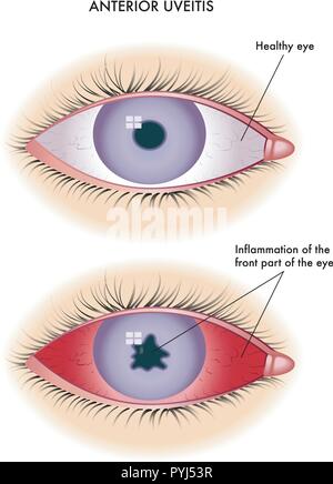 Medizinische Illustration der Symptome einer Uveitis Stock Vektor