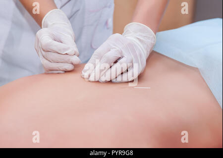 Nahaufnahme der Frau mit einer Nadel in eine Akupunktur Therapie. Stockfoto