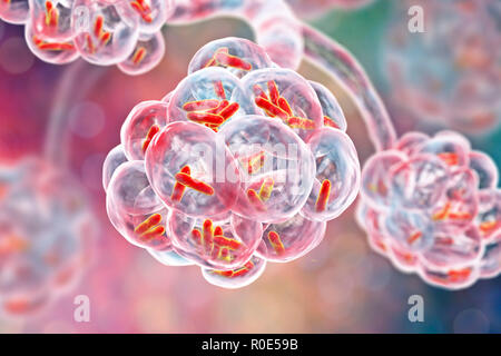 Bakterielle Pneumonie. Computer Abbildung: stabförmige Bakterien (Bakterien) in den Alveolen der Lunge, was zu einer Infektion der unteren Atemwege. Das ist im Allgemeinen als Lungenentzündung bekannt, obwohl der Begriff auch für bestimmte Arten von Infektionen reserviert werden kann. Schwere Lungenentzündung diagnostiziert werden von X-ray und mit Antibiotika behandelt. Die alveolen sind der Website der Gasaustausch zwischen der Luft in die Lunge und das Blut. Stockfoto