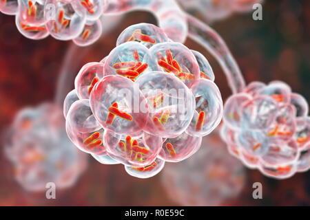Bakterielle Pneumonie. Computer Abbildung: stabförmige Bakterien (Bakterien) in den Alveolen der Lunge, was zu einer Infektion der unteren Atemwege. Das ist im Allgemeinen als Lungenentzündung bekannt, obwohl der Begriff auch für bestimmte Arten von Infektionen reserviert werden kann. Schwere Lungenentzündung diagnostiziert werden von X-ray und mit Antibiotika behandelt. Die alveolen sind der Website der Gasaustausch zwischen der Luft in die Lunge und das Blut. Stockfoto