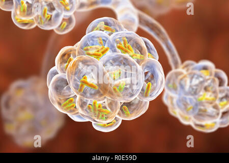 Bakterielle Pneumonie. Computer Abbildung: stabförmige Bakterien (Bakterien) in den Alveolen der Lunge, was zu einer Infektion der unteren Atemwege. Das ist im Allgemeinen als Lungenentzündung bekannt, obwohl der Begriff auch für bestimmte Arten von Infektionen reserviert werden kann. Schwere Lungenentzündung diagnostiziert werden von X-ray und mit Antibiotika behandelt. Die alveolen sind der Website der Gasaustausch zwischen der Luft in die Lunge und das Blut. Stockfoto