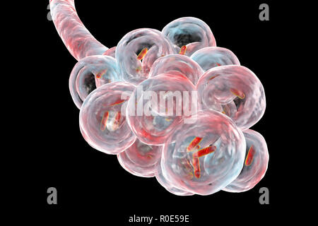 Bakterielle Pneumonie. Computer Abbildung: stabförmige Bakterien (Bakterien) in den Alveolen der Lunge, was zu einer Infektion der unteren Atemwege. Das ist im Allgemeinen als Lungenentzündung bekannt, obwohl der Begriff auch für bestimmte Arten von Infektionen reserviert werden kann. Schwere Lungenentzündung diagnostiziert werden von X-ray und mit Antibiotika behandelt. Die alveolen sind der Website der Gasaustausch zwischen der Luft in die Lunge und das Blut. Stockfoto