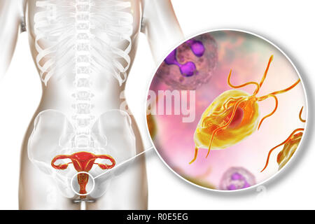 Trichomoniasis, Illustration. Computer Abbildung der weiblichen Geschlechtsorgane und die parasitäre Mikroorganismen Trichomonas vaginalis, dem Erreger der trichomoniasis. Trichomoniasis ist eine häufige Ursache von vaginitis und ist eine sexuell übertragene Krankheit. Stockfoto