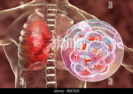 Bakterielle Pneumonie. Computer Abbildung: stabförmige Bakterien (Bakterien) in den Alveolen der Lunge, was zu einer Infektion der unteren Atemwege. Das ist im Allgemeinen als Lungenentzündung bekannt, obwohl der Begriff auch für bestimmte Arten von Infektionen reserviert werden kann. Schwere Lungenentzündung diagnostiziert werden von X-ray und mit Antibiotika behandelt. Die alveolen sind der Website der Gasaustausch zwischen der Luft in die Lunge und das Blut. Stockfoto