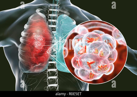 Bakterielle Pneumonie. Computer Abbildung: stabförmige Bakterien (Bakterien) in den Alveolen der Lunge, was zu einer Infektion der unteren Atemwege. Das ist im Allgemeinen als Lungenentzündung bekannt, obwohl der Begriff auch für bestimmte Arten von Infektionen reserviert werden kann. Schwere Lungenentzündung diagnostiziert werden von X-ray und mit Antibiotika behandelt. Die alveolen sind der Website der Gasaustausch zwischen der Luft in die Lunge und das Blut. Stockfoto