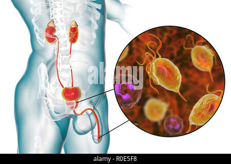 Trichomoniasis. Computer Bild der männlichen Harnwege und die parasitäre Mikroorganismen Trichomonas vaginalis, dem Erreger der trichomoniasis. Trichomoniasis ist eine häufige Ursache von Urethritis, Prostatitis bei Männern und ist eine sexuell übertragene Krankheit. Stockfoto