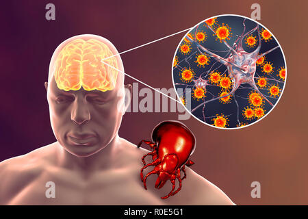 Tick-bourne Enzephalitis, computer Abbildung. Durch Zecken übertragene Enzephalitis (Entzündung des Gehirns) umfasst eine Reihe von Erkrankungen, die von einer schweren Lähmungen Gehirnentzündung, die in Sibirien auftritt und durch Ixodes persulcatus übertragen werden, zu einer weniger gelähmten Gehirnentzündung, die in Mitteleuropa gefunden wird und durch Ixodes ricinus übertragen. Land- und forstwirtschaftliche Arbeiter sind am häufigsten betroffen, da die Schwerpunkte der Infektion sind in und um den Wald, der Wirbeltiere Wartungshosts, Nagetiere und Boden lebende Vögel. Stockfoto