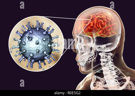 Enzephalitis, die durch Varicella zoster Virus (VZV), computer Abbildung. VZV, ein Virus aus der Familie Herpesviridae, ist der Erreger von Windpocken und Gürtelrose. Enzephalitis (Entzündung des Gehirns) ist eine der Komplikationen von windpocken Infektion. Stockfoto