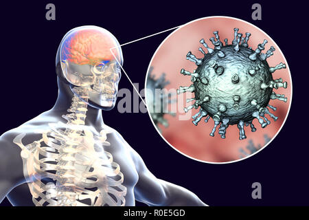 Enzephalitis, die durch Varicella zoster Virus (VZV), computer Abbildung. VZV, ein Virus aus der Familie Herpesviridae, ist der Erreger von Windpocken und Gürtelrose. Enzephalitis (Entzündung des Gehirns) ist eine der Komplikationen von windpocken Infektion. Stockfoto