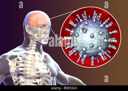 Enzephalitis, die durch Varicella zoster Virus (VZV), computer Abbildung. VZV, ein Virus aus der Familie Herpesviridae, ist der Erreger von Windpocken und Gürtelrose. Enzephalitis (Entzündung des Gehirns) ist eine der Komplikationen von windpocken Infektion. Stockfoto