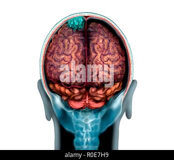 Hirntumor (blau), Magnetresonanztomographie (MRT) scannen und Illustration. Dies ist ein konvexität Meningeom im parietalen Lappen des Gehirns. Meningeome sind Krebse der Membranen (Meningen), die das Gehirn. Konvexität Meningeome sind auf der Oberfläche des Gehirns gefunden. Stockfoto