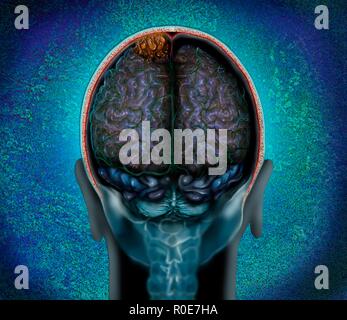 Hirntumor (braun, Oben), Magnetresonanztomographie (MRT) scannen und Illustration. Dies ist ein konvexität Meningeom im parietalen Lappen des Gehirns. Meningeome sind Krebse der Membranen (Meningen), die das Gehirn. Konvexität Meningeome sind auf der Oberfläche des Gehirns gefunden. Stockfoto
