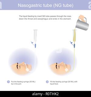 Die Flüssigkeit Fütterung von Einfügen NG-Sonde durch die Nase, die in der Kehle und in der Speiseröhre und im Magen. Abbildung: Grafik. Stock Vektor