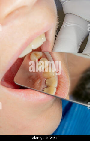 Zahnärztliche Behandlung in der Zahnarztpraxis. Faule kariösen Zahn Nahaufnahme Makro. Behandlung der endodontischen Kanäle Stockfoto