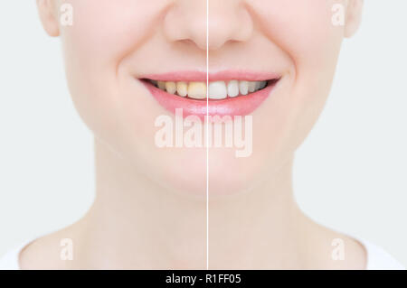 Perfektes Lächeln vor und nach dem Bleichen. Zahnpflege und Bleichen von Zähnen. Gesicht Nahaufnahme. Stockfoto