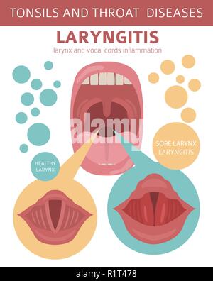 Mandeln HNO-Krankheiten. Laryngitis Symptome, Behandlung Icon Set. Medizinische Infografik Design. Vector Illustration Stock Vektor