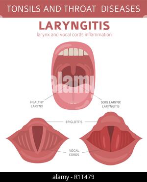 Mandeln HNO-Krankheiten. Laryngitis Symptome, Behandlung Icon Set. Medizinische Infografik Design. Vector Illustration Stock Vektor