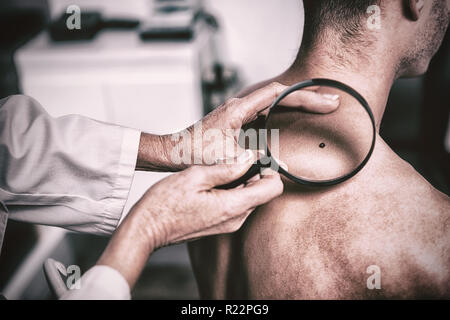 Hautarzt untersuchen Maulwurf mit Lupe Stockfoto