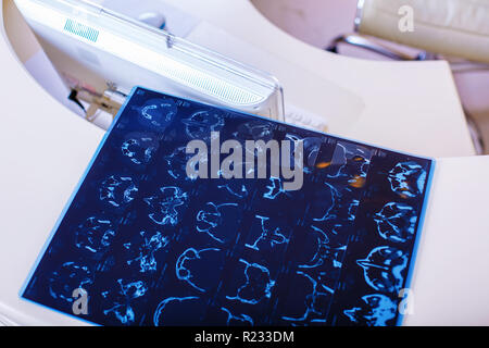 X-ray Film des Kopfes Computertomographie Stockfoto